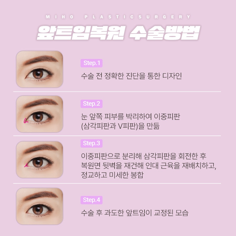 앞트임복원 새롭게 자리 잡도록 관련 이미지 3