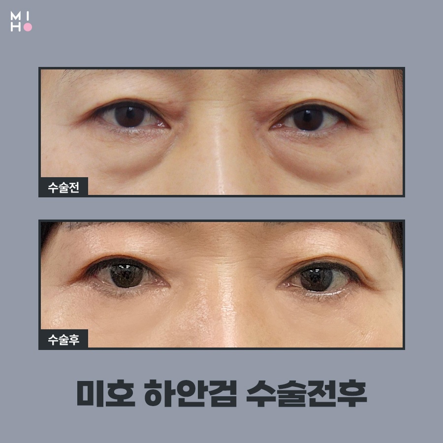 하안검수술 이미지 변신도 안전하게 관련 이미지 8