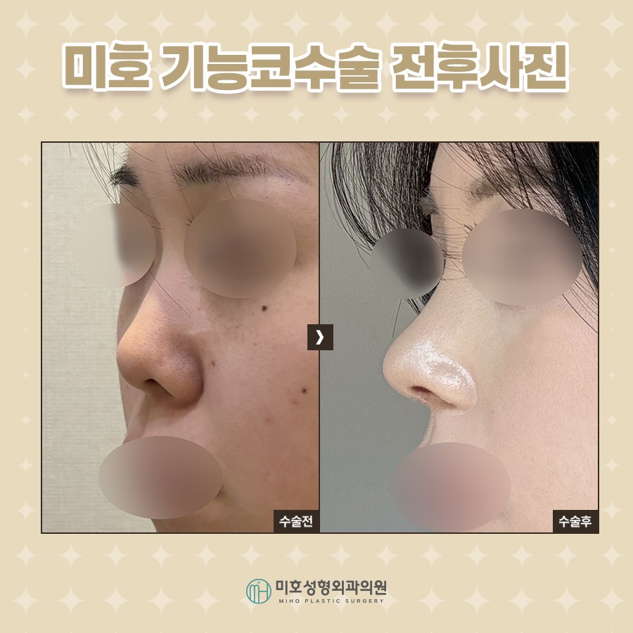 While Adjusting the Shape During Nasal Valve Reconstruction image 10
