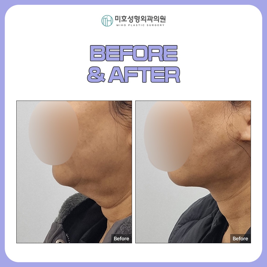 Looking at the Progress of Chin Muscle Ligation for a Double Chin image 8