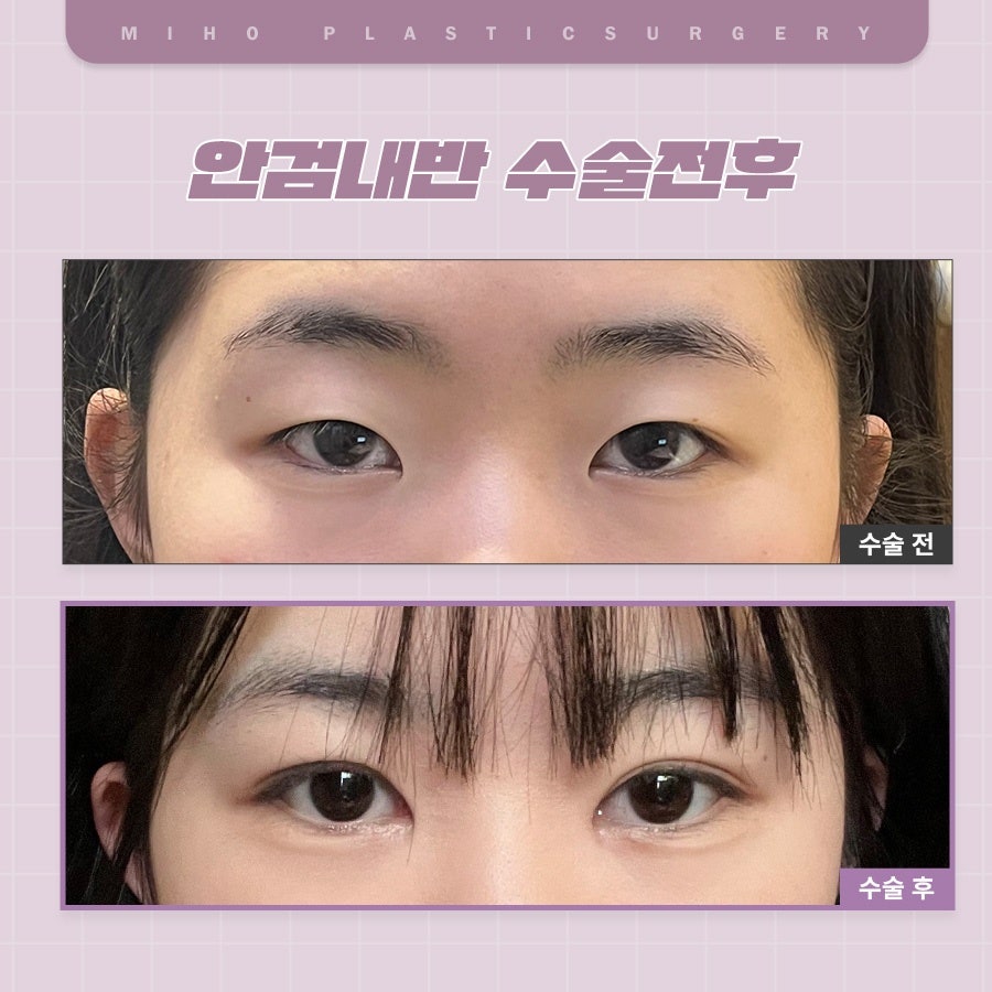안검내반 속눈썹찔림 원인과 관리 관련 이미지 18