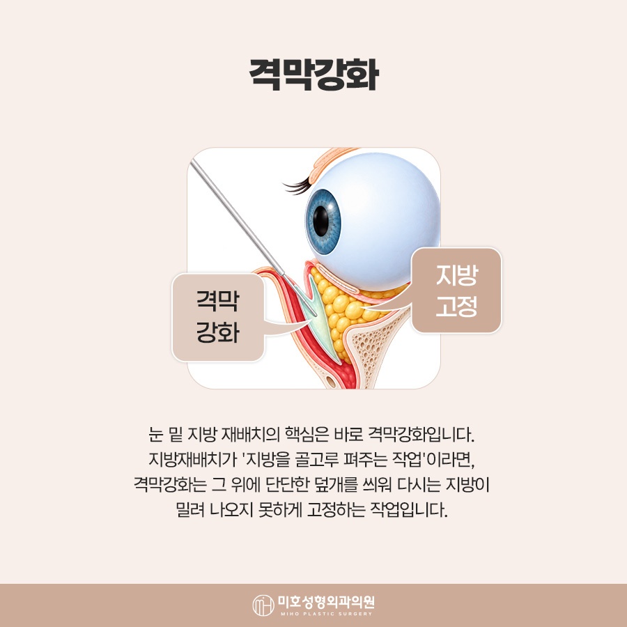 눈밑지방재배치수술후 회복 흐름 살펴봐야 관련 이미지 5