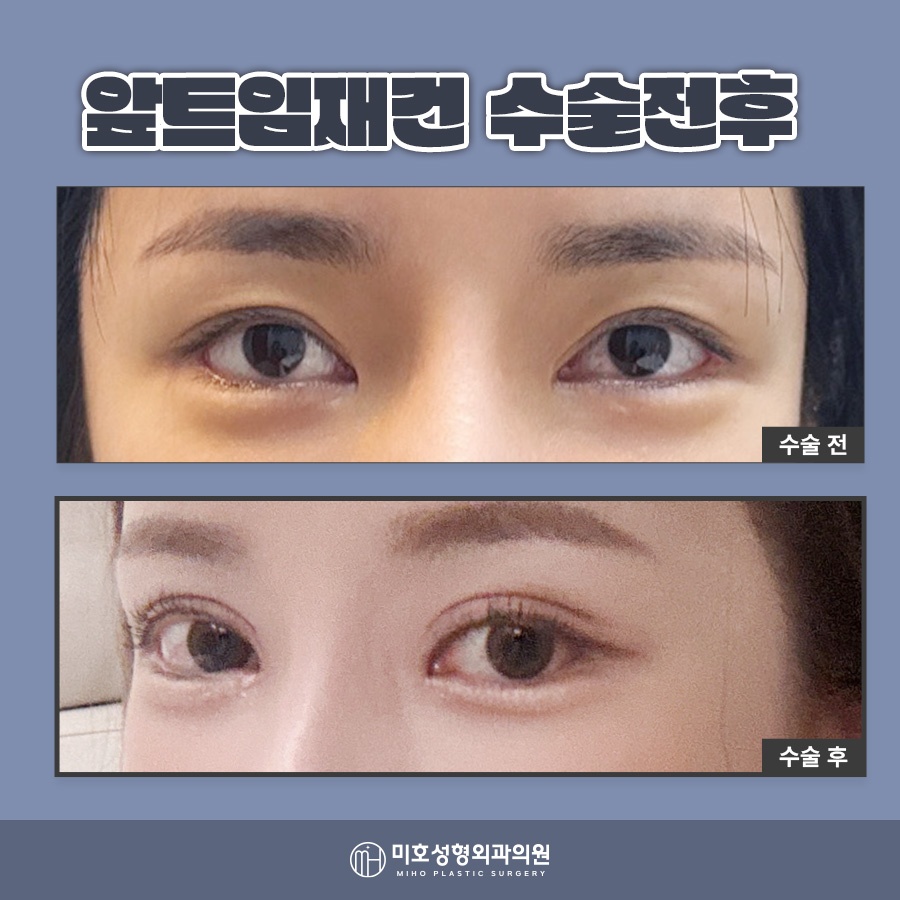앞트임재건 미세함의 차이로 관련 이미지 9