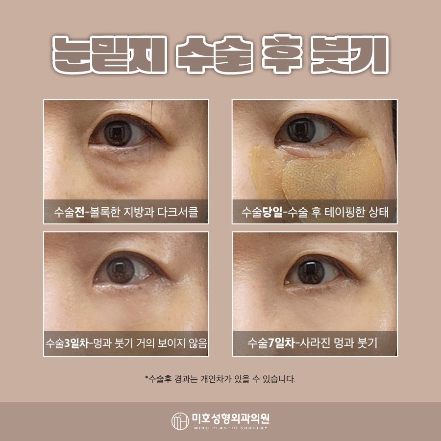 눈밑지붓기 원인 기간을 고려하여 관련 이미지 6