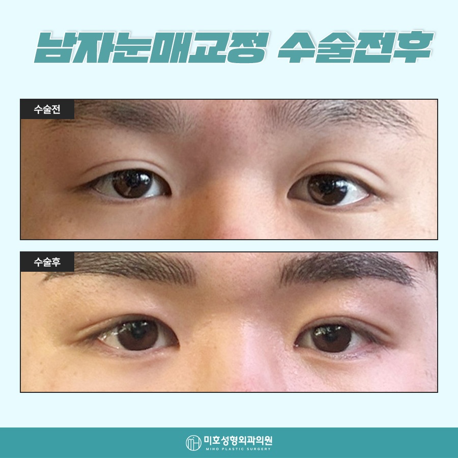 Natural-Looking Male Eye Shape Correction image 8