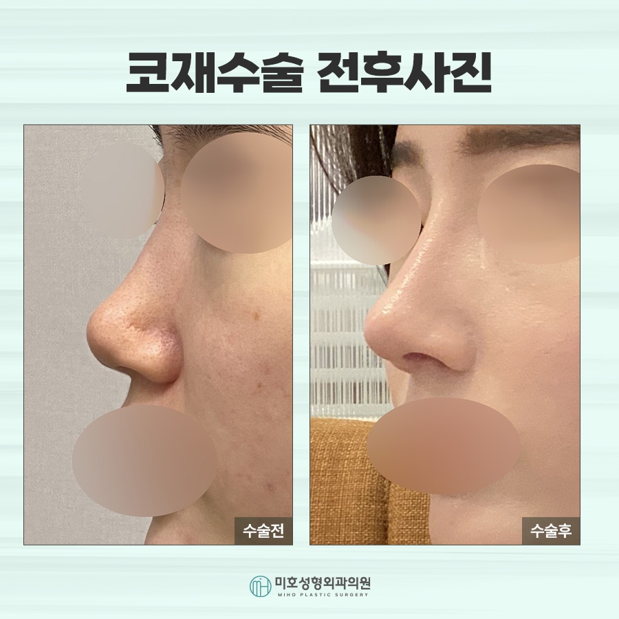 신논현코재수술 체크포인트 관련 이미지 7