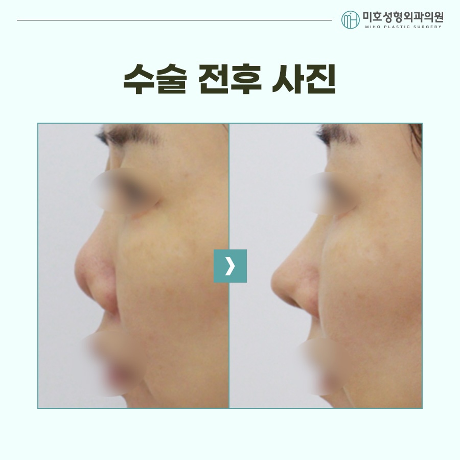 Natural Correction of an Upturned Nose image 8