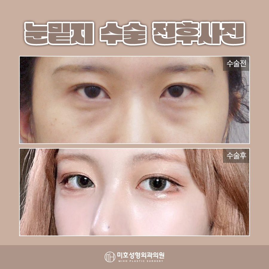 눈밑지붓기 원인 기간을 고려하여 관련 이미지 7