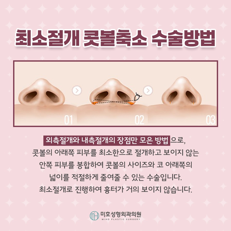 콧볼축소 자연스러운 결과로 관련 이미지 6