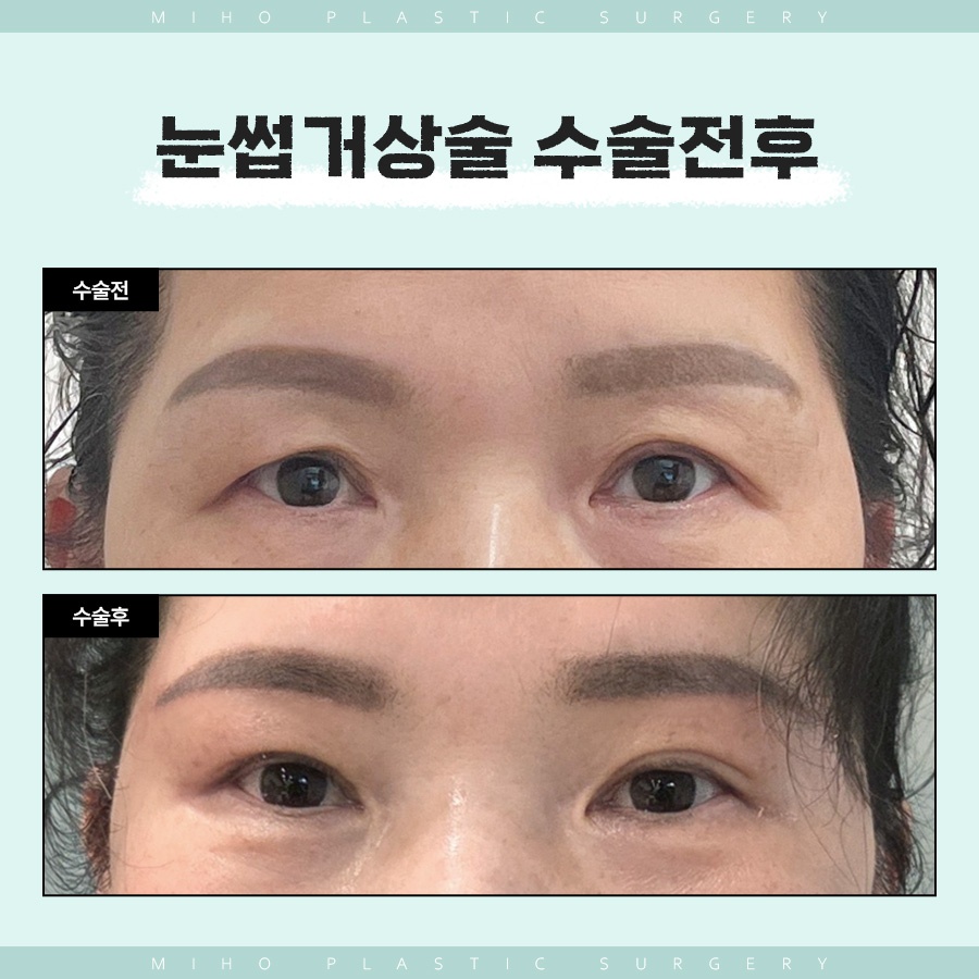 눈썹거상술 인위적이지 않은 변화 관련 이미지 7