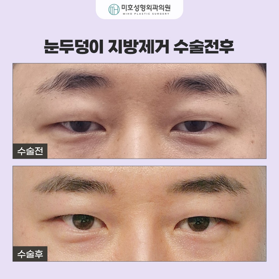 눈두덩이지방제거 눈매 개선 가이드 관련 이미지 6