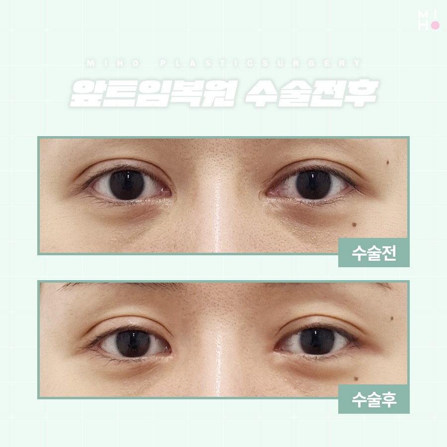 앞트임복원 필요한 상황을 확인하여 관련 이미지 8