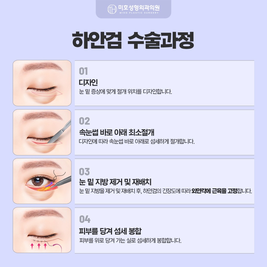 하안검수술 아래쪽 변화가 고민이라면 관련 이미지 4