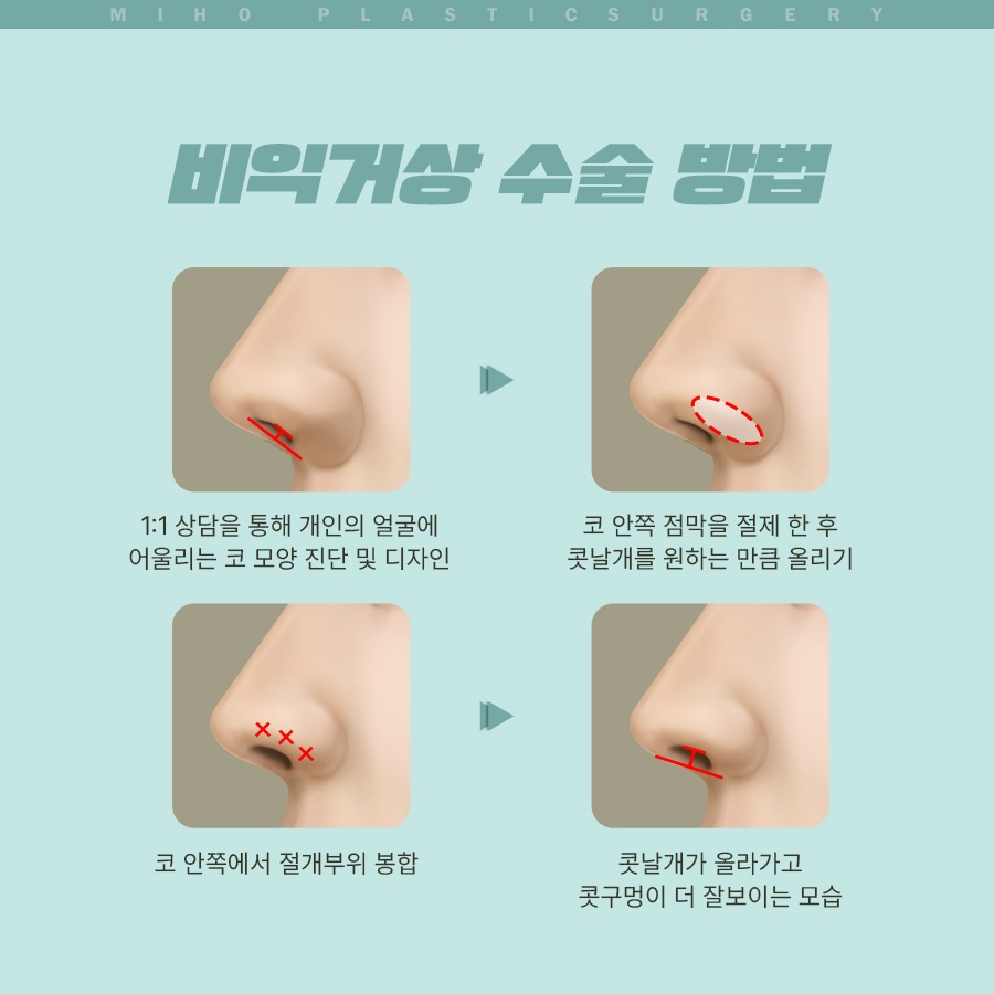 Creating a Naturally Refined Nose with an Alar Lift image 5