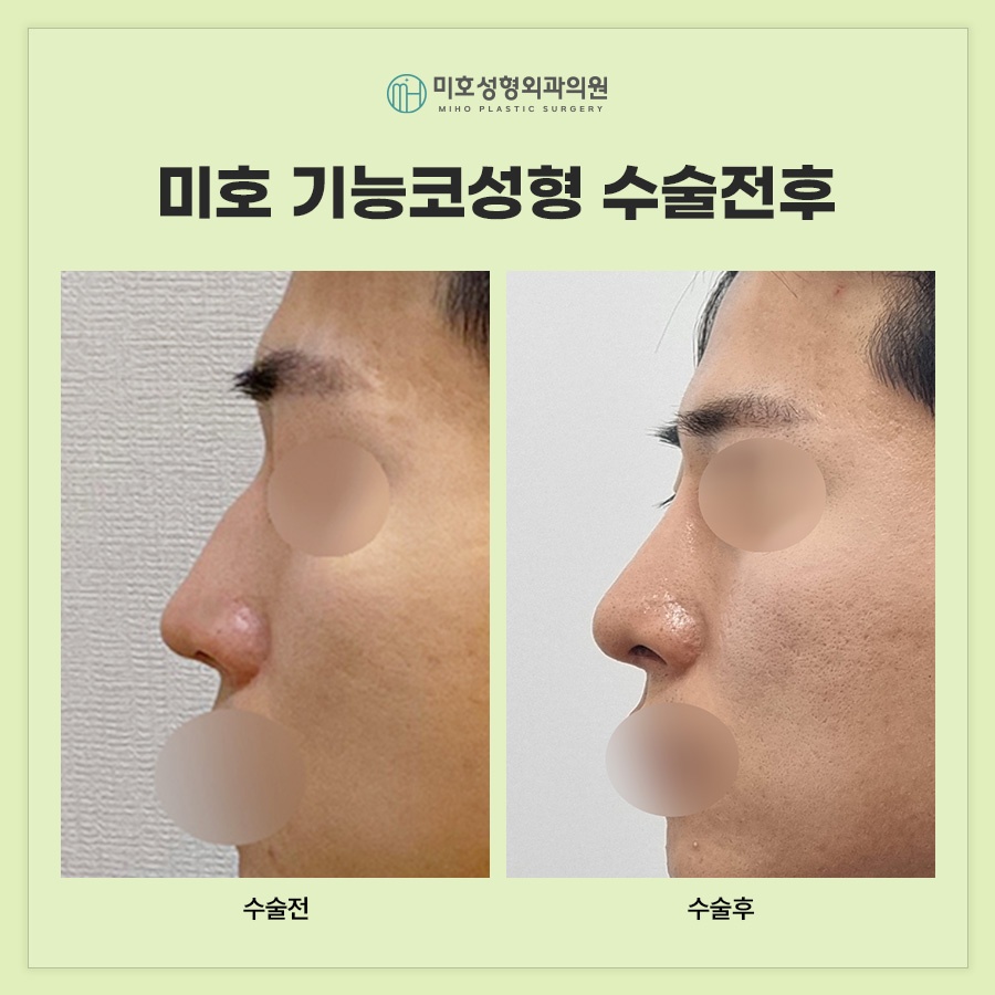 기능코 편안하고 아름다운 비결 관련 이미지 10