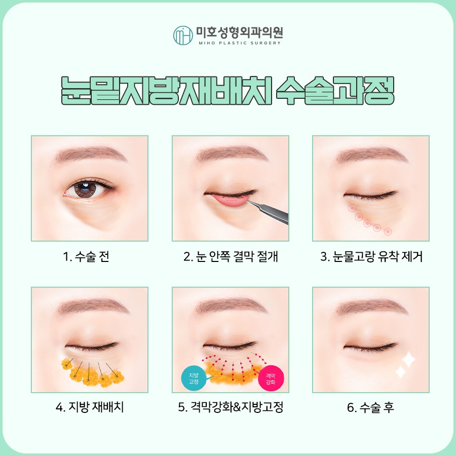 눈밑지 후기보다 의료진 실력이 중요 관련 이미지 5