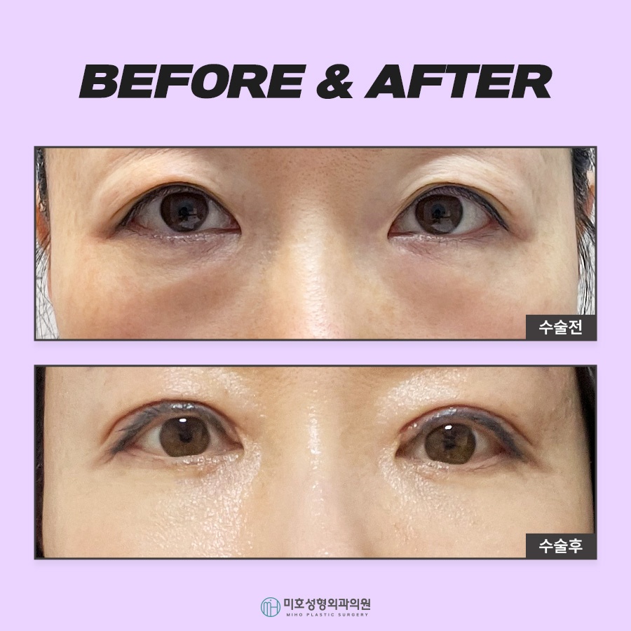 눈밑지방재배치로 젊음을 획득 관련 이미지 7