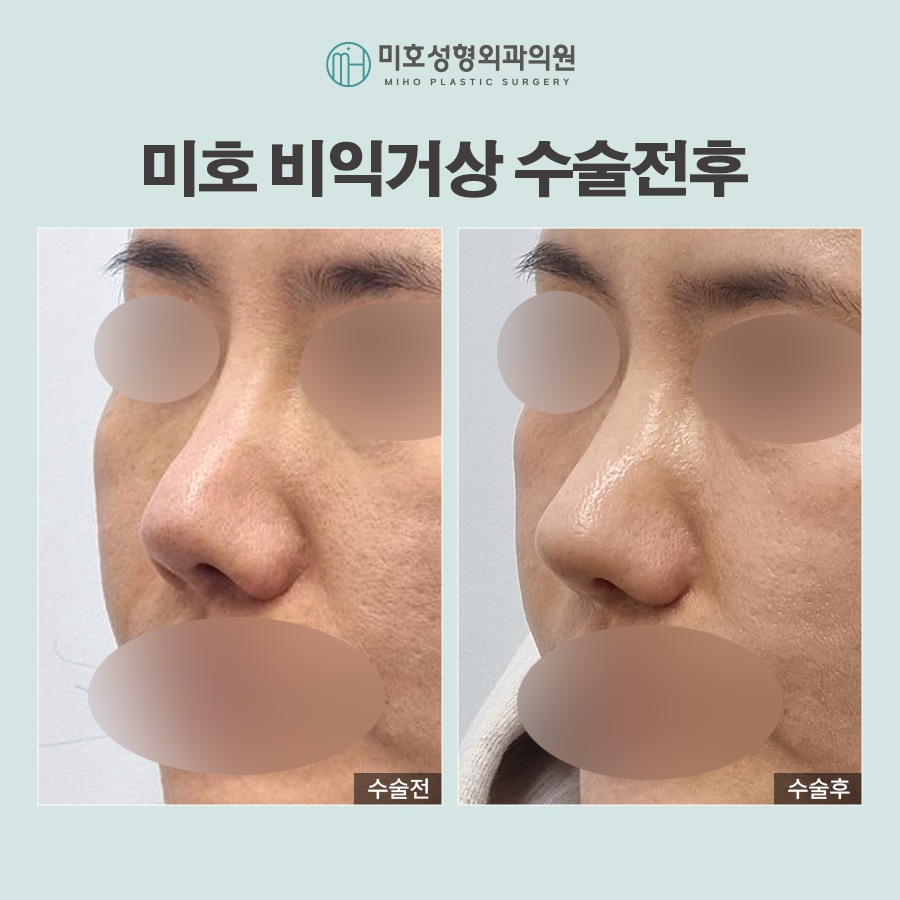 미호 비익거상 자연스러운 콧날개올리기 비율교정! 관련 이미지 8