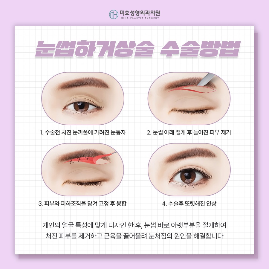 눈썹하거상술 비용과 후기 흉터 궁금하다면 관련 이미지 5