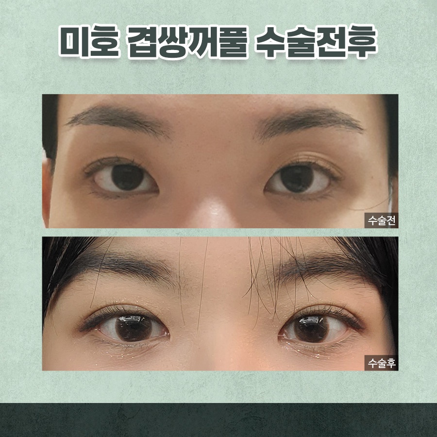 겹주름교정 자연스럽게 완성하려면 관련 이미지 8