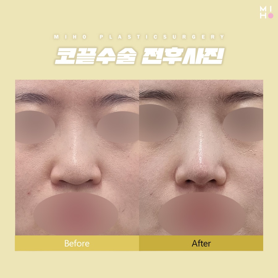 Considering Harmony in Tip Rhinoplasty image 7