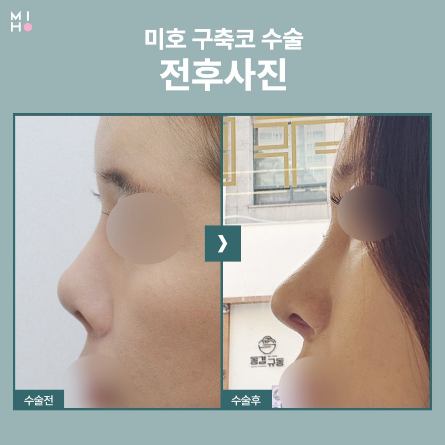 When Is Improvement for a Contracted Nose Needed? image 10