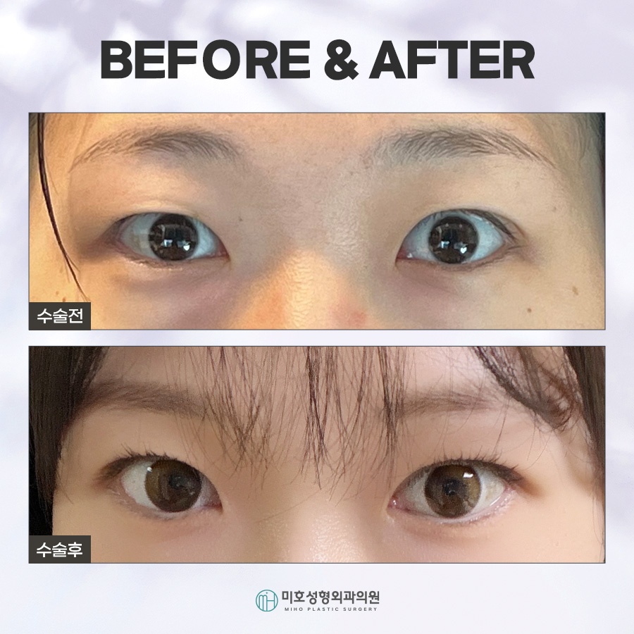 속쌍눈매교정에 관심을 두고 있다면 관련 이미지 9