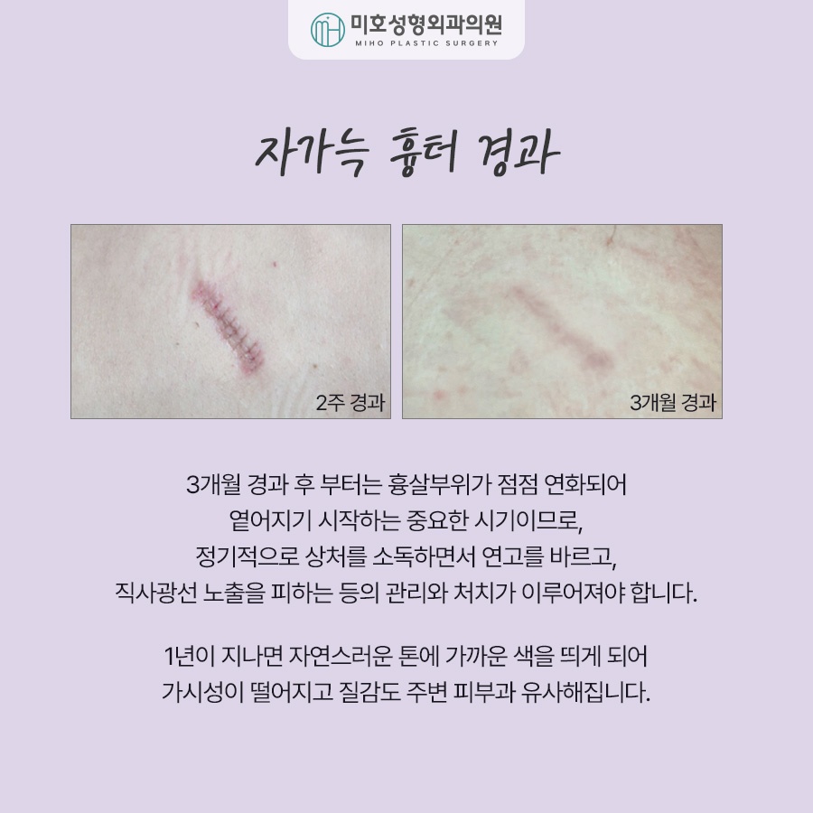 For a Natural-Looking Result with Costal Cartilage Nose Surgery image 6