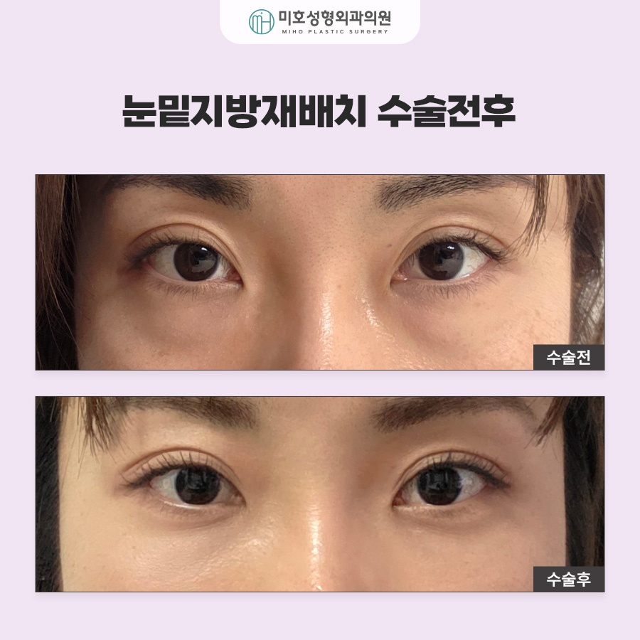 To Learn About Under-Eye Fat Graft Reviews, Methods, Swelling, and Recovery image 9