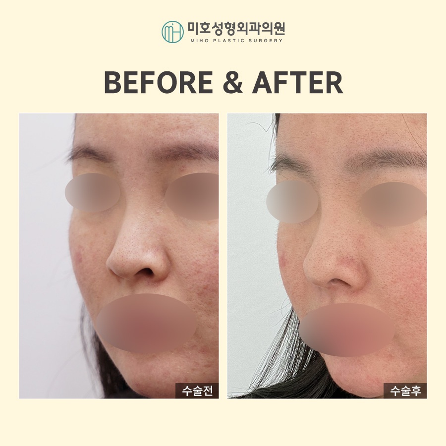 Adjusting the Approach According to the Type of Nostril-Lowering Procedure image 7