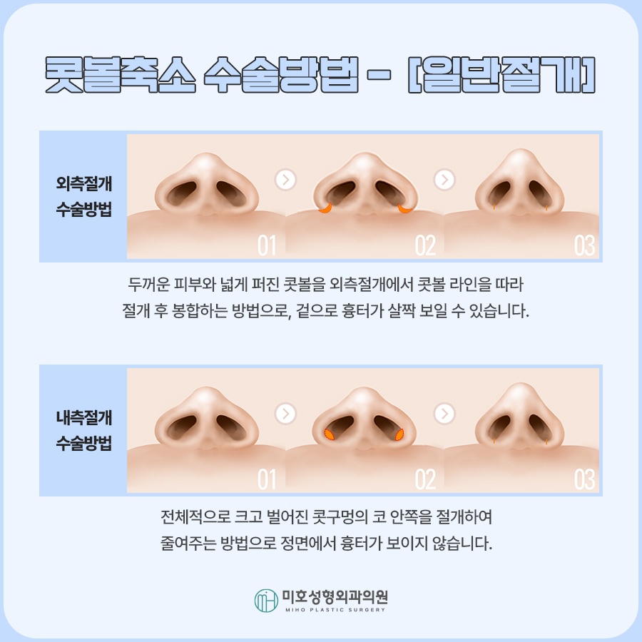 콧볼축소 세밀한 분석을 통해 관련 이미지 5