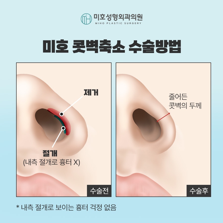 미호 콧벽축소 콧볼축소 방법과 주의 사항 총정리 관련 이미지 3