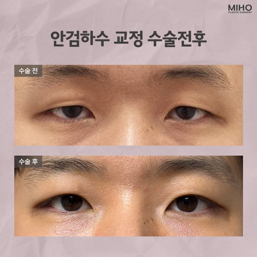 안검하수 발생 요인과 증상에 맞춰 관련 이미지 8