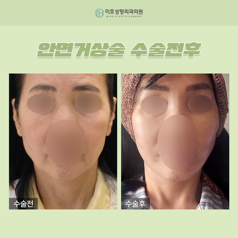 Wondering About the Side Effects of a Facelift? image 7