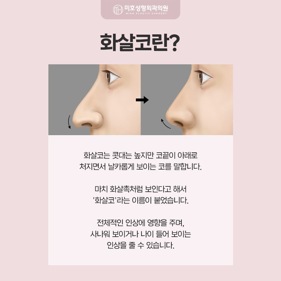 화살코 형태의 원인과 개선 방법 관련 이미지 2