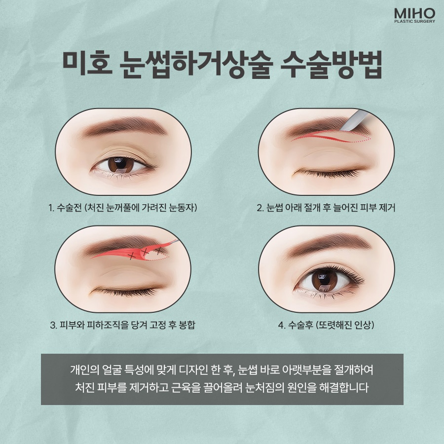 Sub-Brow Lift Scar, Cost, Recovery Process, Information, and Review image 5
