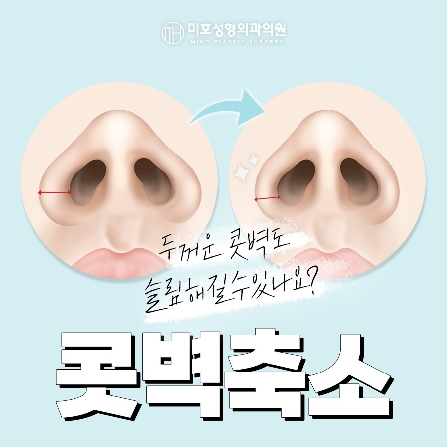 미호 콧벽축소 콧볼축소 방법과 주의 사항 총정리 관련 이미지 1