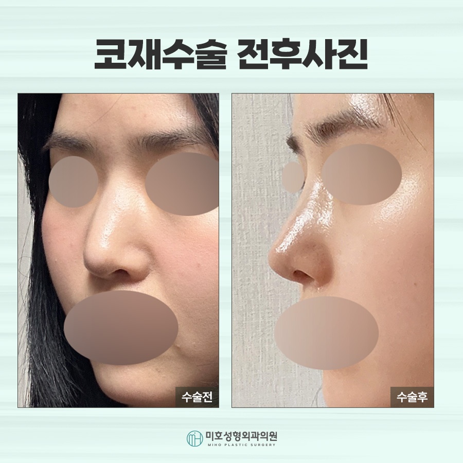 신논현코재수술 체크포인트 관련 이미지 10