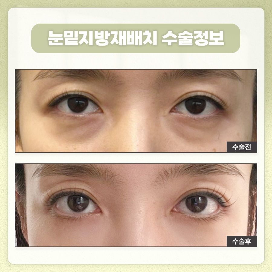 눈밑지방재배치 피로한 인상을 관련 이미지 9
