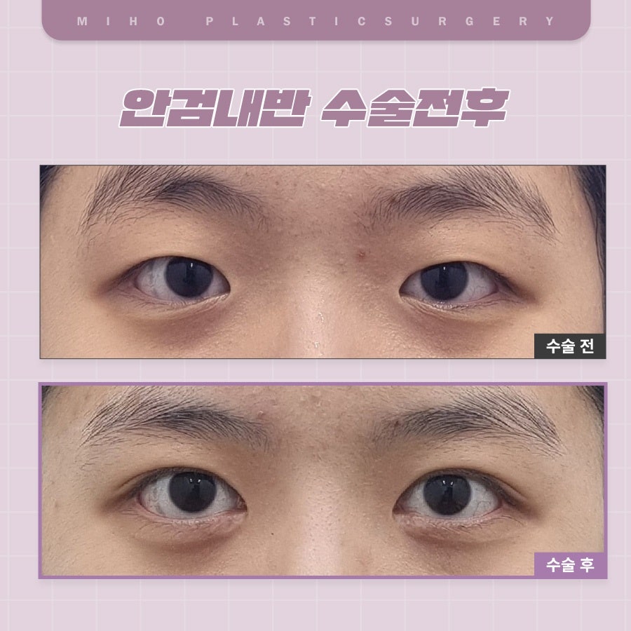 안검내반 속눈썹찔림 원인과 관리 관련 이미지 16