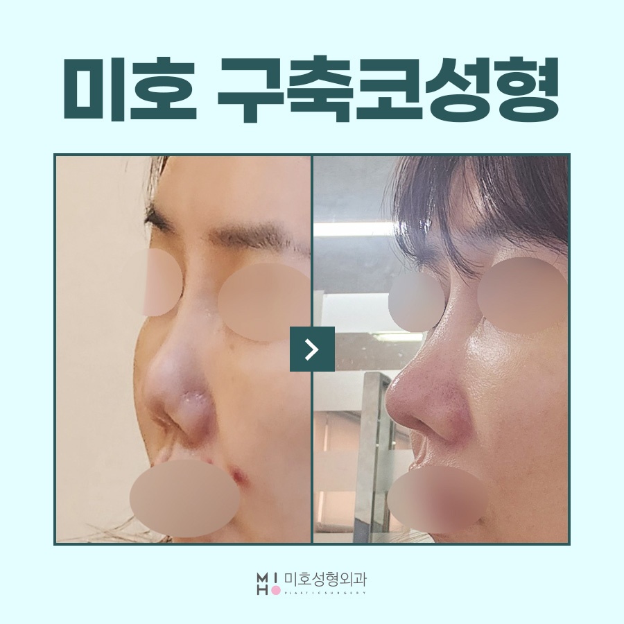 When Is Improvement for a Contracted Nose Needed? image 1