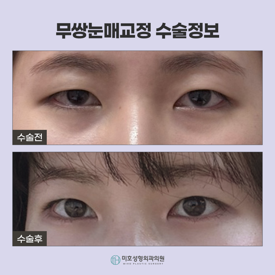 무쌍눈매교정 자연스러운 눈매 완성 관련 이미지 8