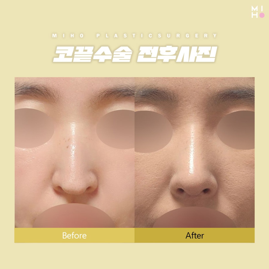 Considering Harmony in Tip Rhinoplasty image 6