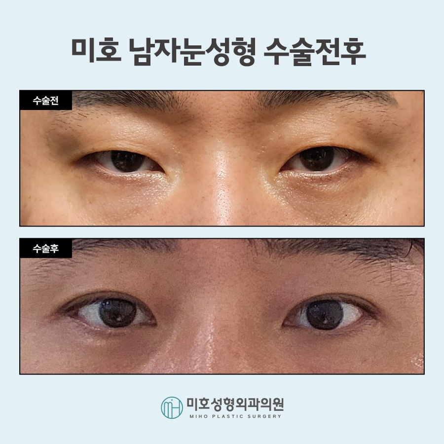 Focusing on a Natural Look in Male Eye Surgery image 8
