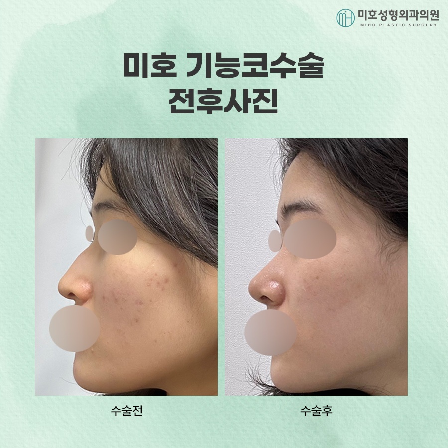 The Progression of a Deviated Nasal Septum and Precautions image 9