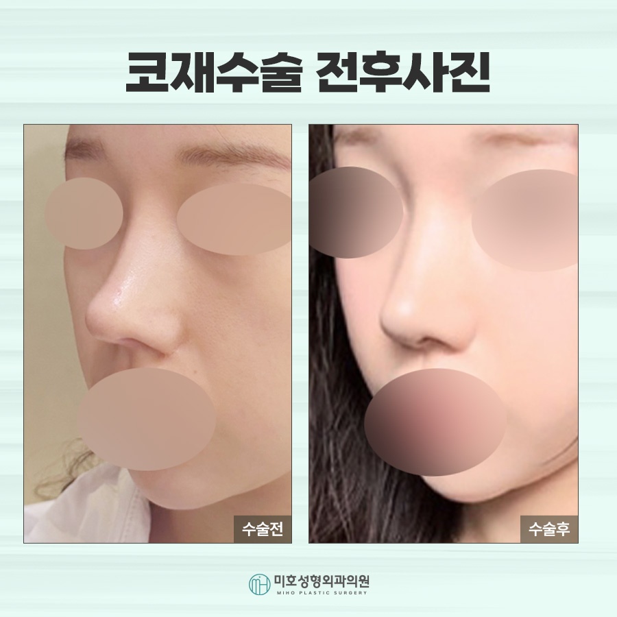 신논현코재수술 체크포인트 관련 이미지 8