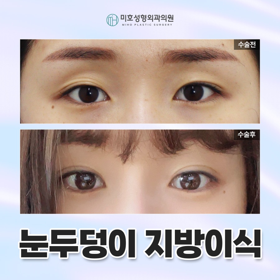 Upper Eyelid Fat Grafting to Improve Hollow Eyes and Make Them Look More Lively image 1