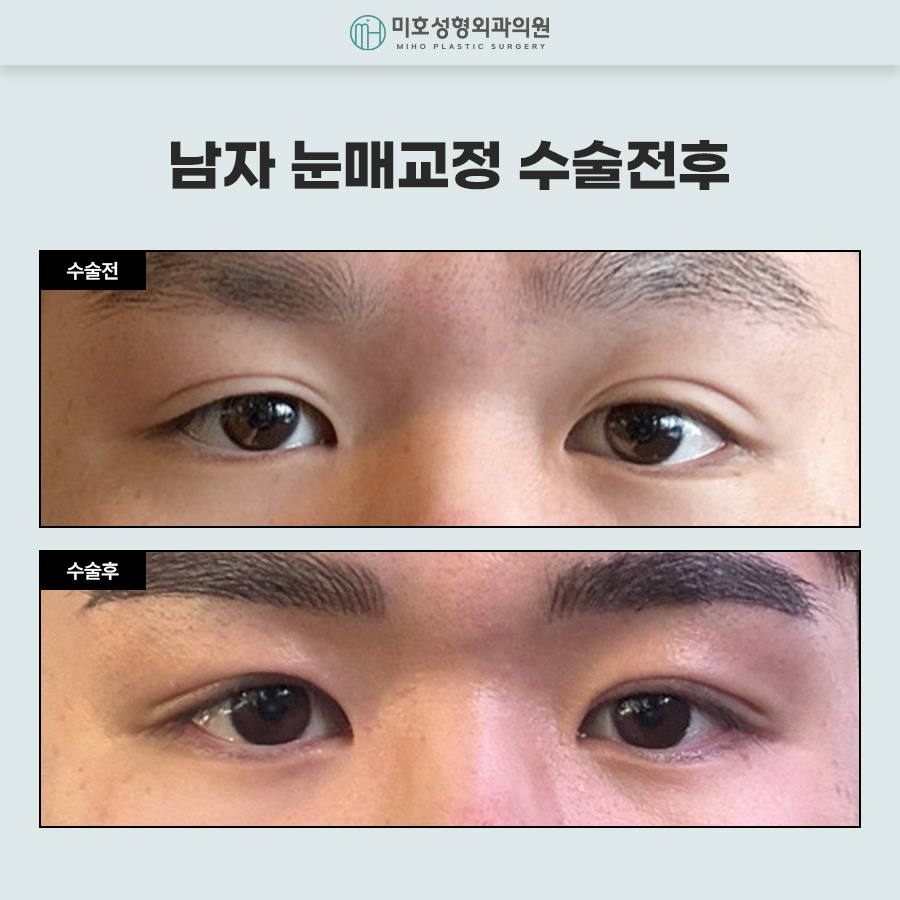 Naturally Defined Eyes with Male Eye-Shape Correction image 8