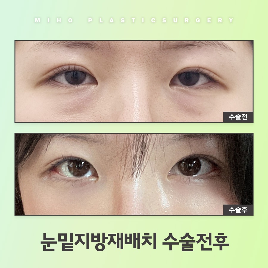 눈밑지방재배치 고민에 맞게 개선하며 관련 이미지 7