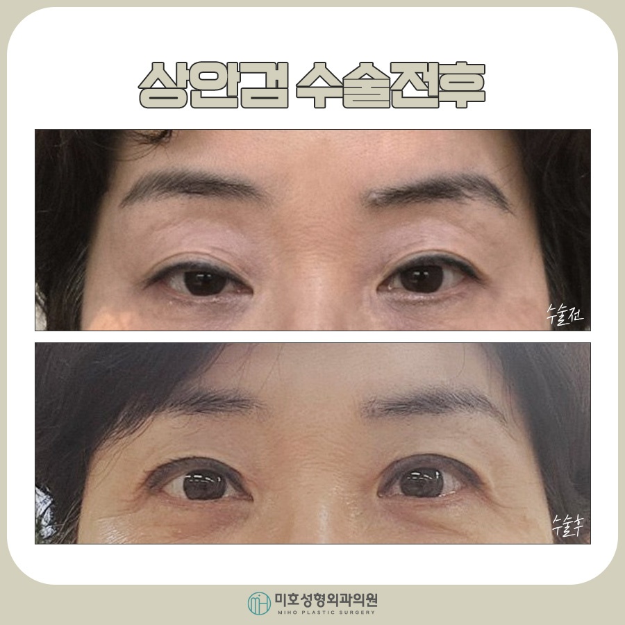 Factors to Consider for Upper Eyelid Surgery Costs image 10